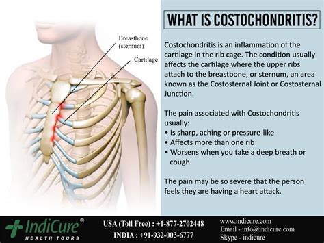 Costochondritis (inflammation where your bones and cartilage meet in your rib cage). . Tightness around rib cage under breasts